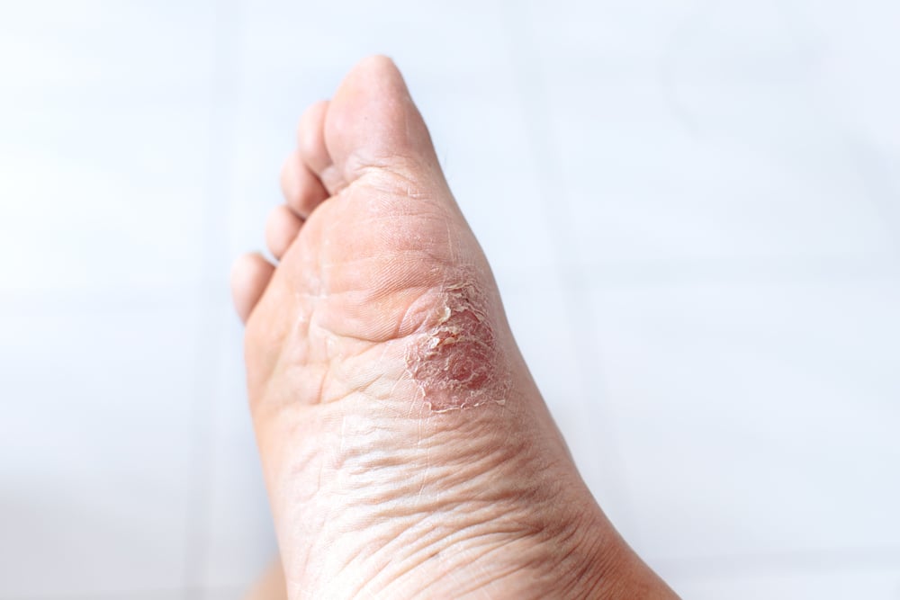 How to Prevent Athlete’s Foot